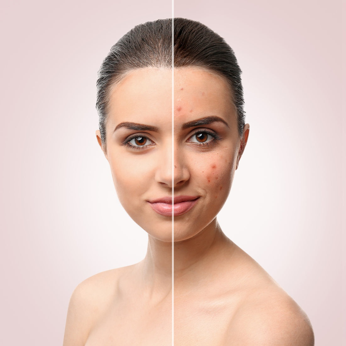LIFESTYLE CHANGES THAT CAN HELP ACNE